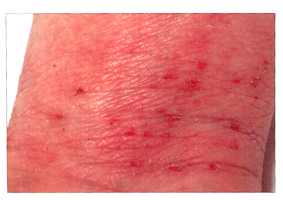 will-habit-reversal-help-my-eczema