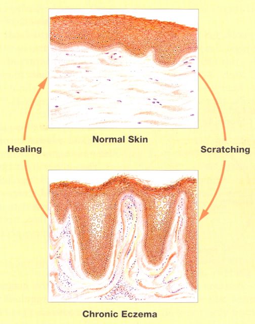 understanding-the-vicious-circle-chronic-eczema