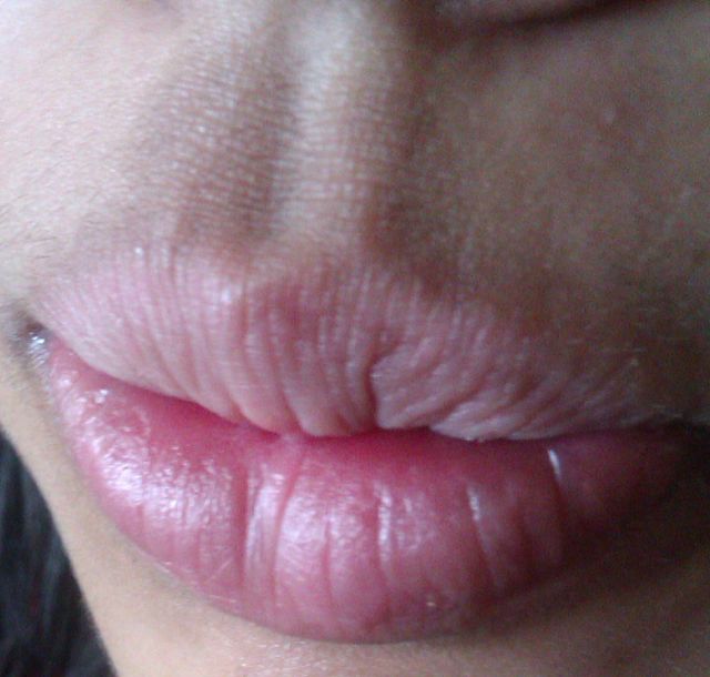 lip-eczema