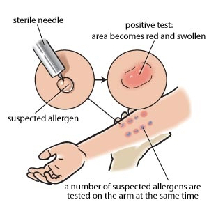 atopic-eczema-allergy-tests