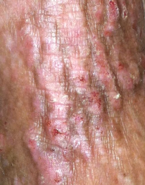 severe-chronic-atopic-eczema