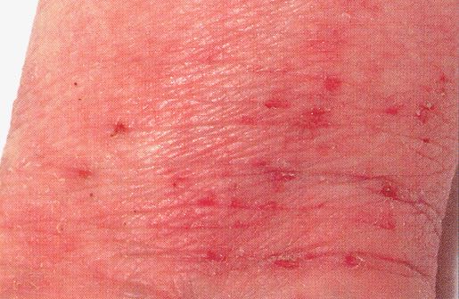 Recognising-habitual-scratching-in-atopic-eczema